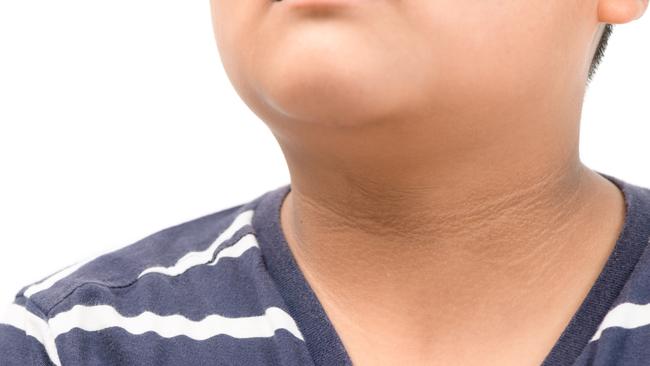 Black skin marks around the neck are a sign of an underlying health problem. Picture: istock