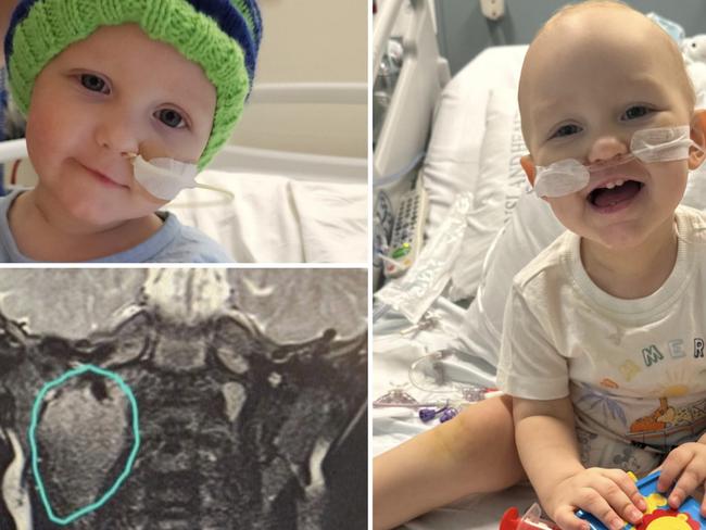 Brave  toddler Archie Down is in the fight of his life after what doctors initially diagnosed as tonsillitis turned out to be an aggressive tumour the size of a golf ball in his neck.