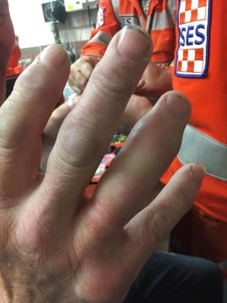 Knox SES volunteers successfully freed the man’s broken finger.