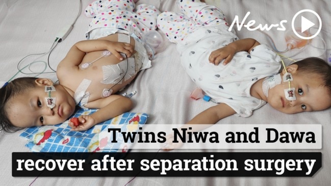 Twins Niwa and Dawa recover after separation surgery