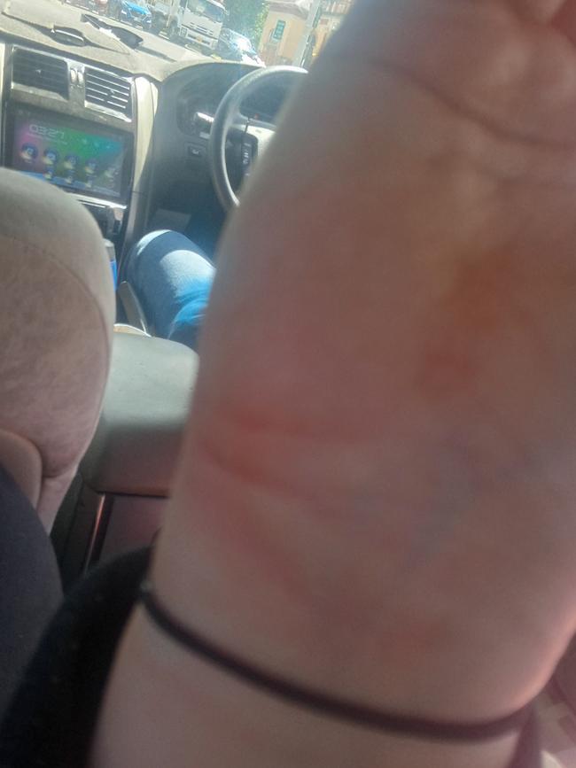 Abrasions on Ms Gavin’s hand sustained as a result of the alleged incident. Picture: Supplied