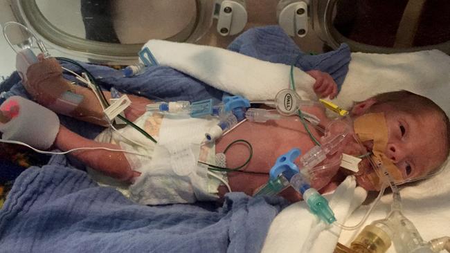 Melbourne baby born at 25 weeks gestation is thriving after his early ...