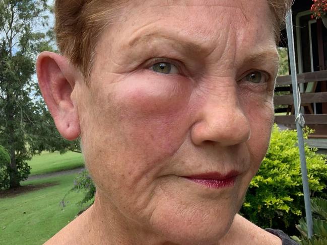 Pauline Hanson suffers ‘painful’ insect stings - but not everyone has sympathy. Picture: Facebook