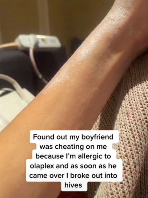 The woman explained her hives were caused by an allergy to a popular beauty product. Picture: TikTok