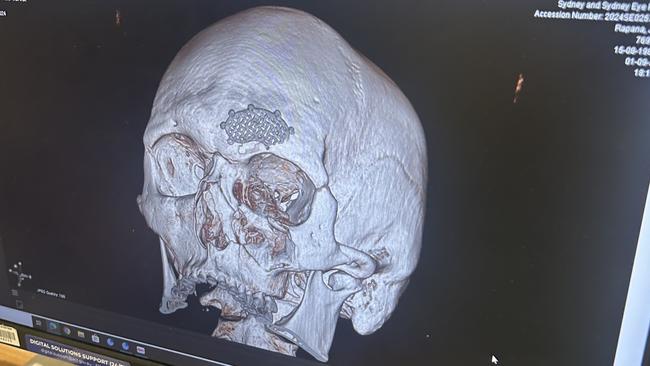 X-rays show the damage sustained to Rapana’s skull throughout his NRL career. Picture: Supplied