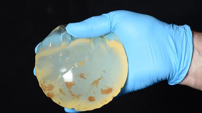 eDodgy breast implant removal