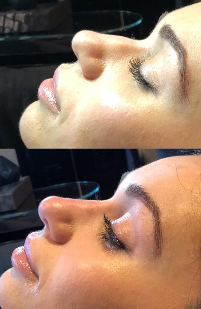 Non-surgical nose jobs involves injecting dermal filler (containing hyaluronic acid) into a hooked nose which takes no more than 15 minutes for instant results.