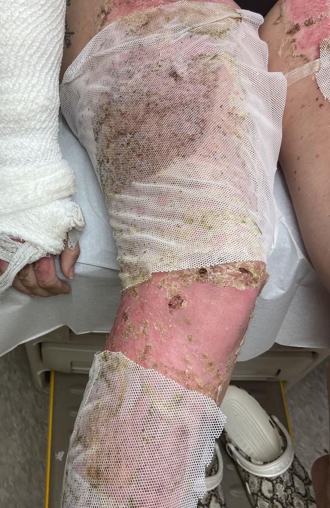 She had to postpone her wedding due to her burns. Picture: Kennedy News and Media