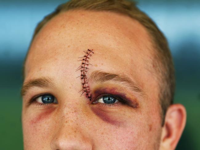 South Sydney Rabbitohs Jason Clark shows off his stitches. Picture. Phil Hillyard