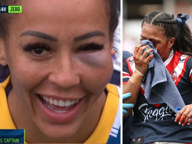 Therese Aiton had a beauty of a shiner and was loving it. Photo: Fox Sports and Getty Images