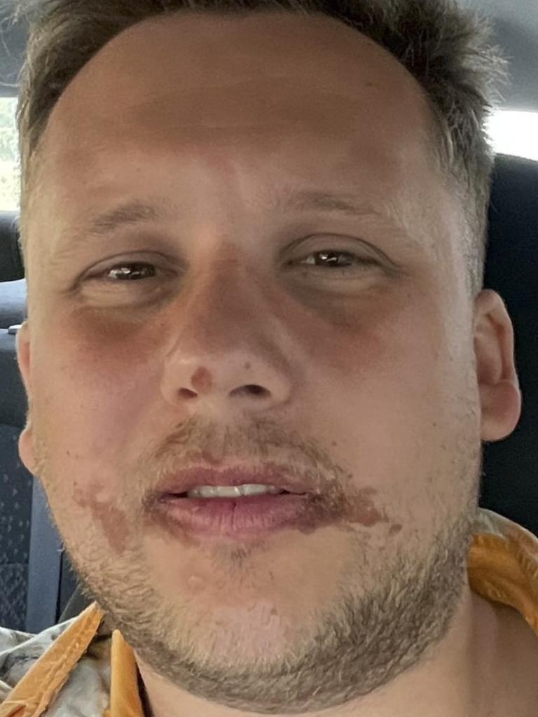 Thomas Harold Watson, 28, was left with scabs and burns on his face after eating a cashew apple in Mexico. Picture: SWNS.