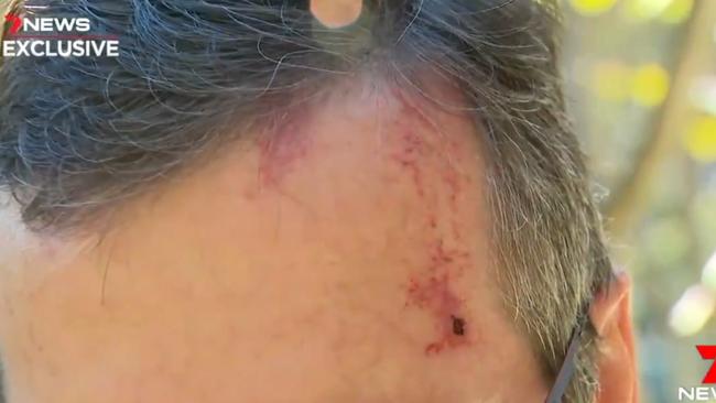 The head injuries to cyclist Mark Royle who was hit by a car on July 19. Picture: 7 News.