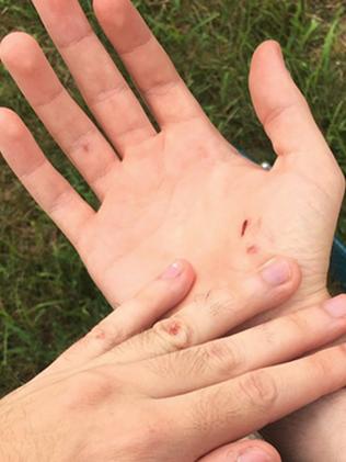 Mike Schultz injured his hand when he fell off his skateboard while searching for the virtual creatures.   Picture: AP