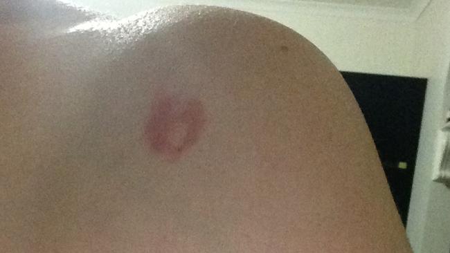 A burn mark on injured woman Heidi Brennan who was burned by liquid from the family's Thermomix. Picture: Supplied