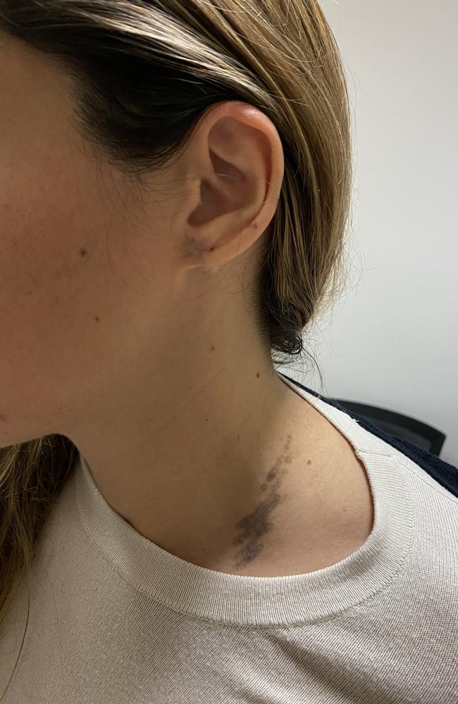 Ipswich woman Johana Perez still has visible scars after the lightning struck and melted her earrings and necklace, damaging her eardrum and neck. Picture: Supplied