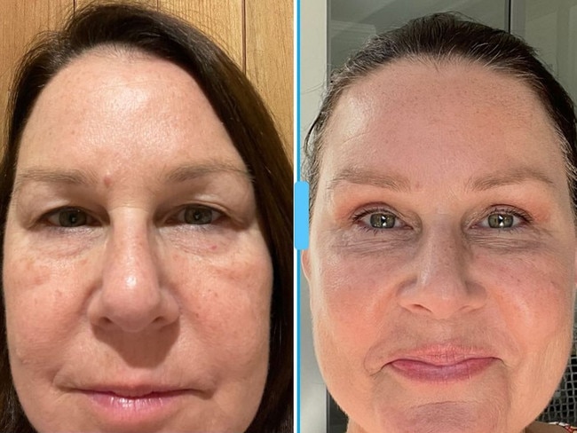 Julia Morris’ post-surgery selfie made me book an appointment with a plastic surgeon. Picture: Supplied/news.com.au