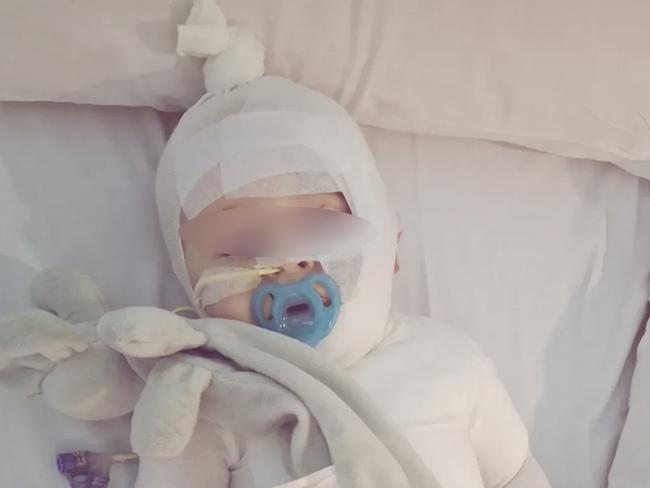 The mother of a baby Luka,, burned by coffee in a shocking random attack in a Brisbane park has shared an incredible update as her son faces his third surgery. Picture: Supplied ,