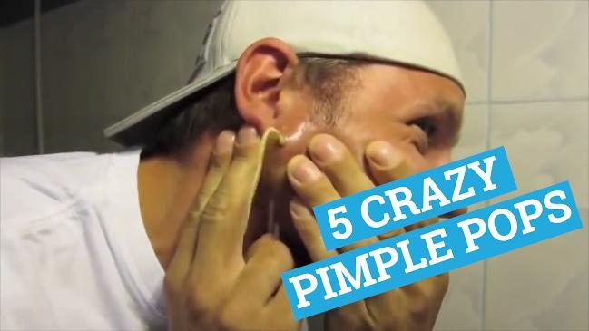 5 of the craziest pimple pops