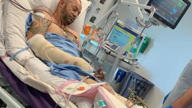 Gavin Zeunert underwent nine hours of surgery and shattered both of his legs after an unlicensed driver allegedly struck him in a hit and run crash. Picture: Supplied