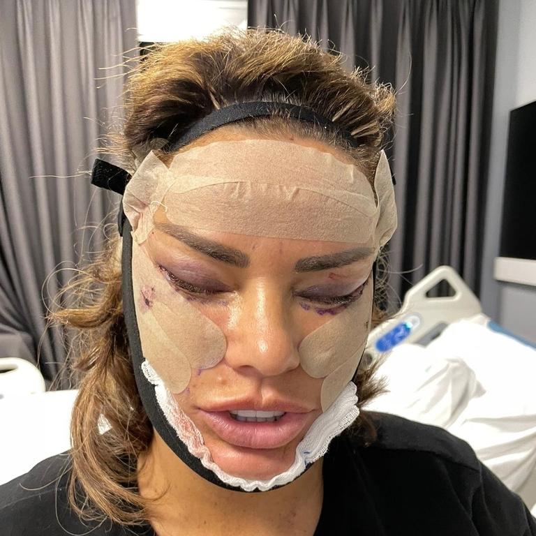 Katie Price unveils brand new face after facelift surgery Herald Sun