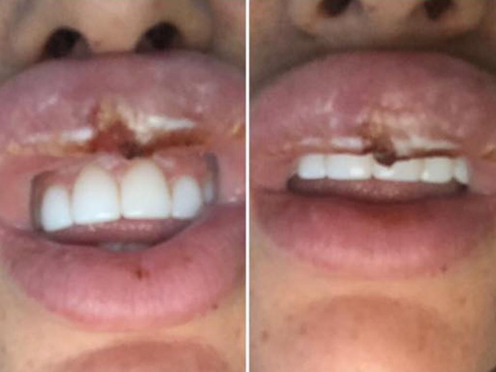 400 Botox Party Leaves Woman In Agony With Swollen Lips Au 7602