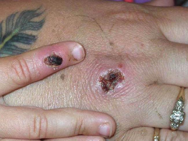 First case of monkeypox virus emerges in Victoria