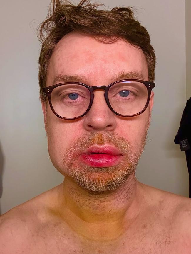 Savage Garden singer Darren Hayes revealed he fell and broke his jaw last month in “a terrible accident”.