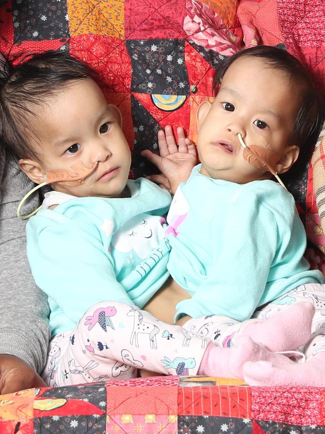 Bhutanese conjoined twins Nima and Dawa. Picture: Alex Coppel