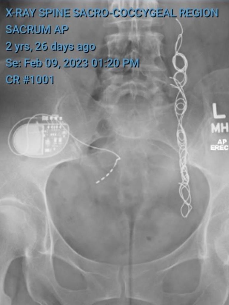 An X-ray shows a sacral nerve stimulator (the oval box with wires) that was implanted to control the incontinence Annabel suffered from the assaults. The wire coils were inserted into her ovarian vein because of a massive blood clot. Picture: Supplied