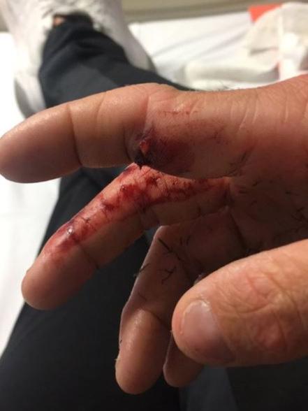 Merrin's Instagram shot of his broken finger.