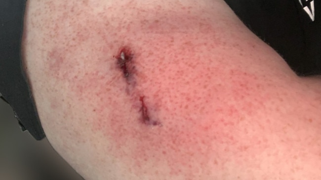 Townsville Ergon Energy meter reader was left with a shocking wound after a pitbull jumped a fence and bit him on the arm while on the job.