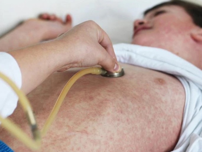 Measles generic. Picture: ACS