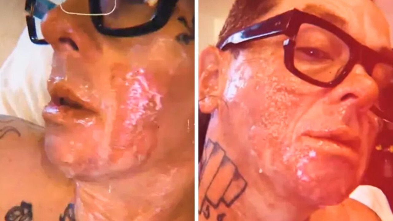 Shocking images of rocker’s ‘melted face’