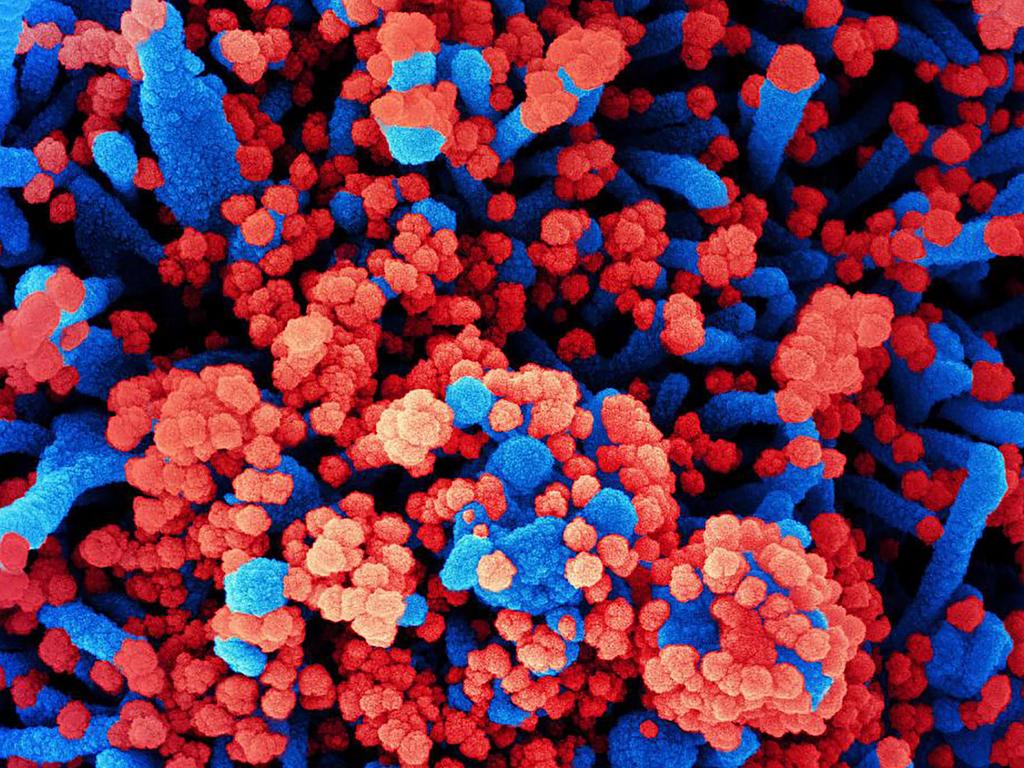 A colorised scanning electron micrograph of a cell (blue) heavily infected with SARS-CoV-2 virus particles (red), isolated from a patient sample. Picture: AFP