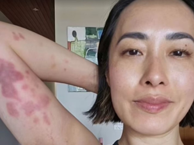 Melissa Leong shows the injuries she sustained after a session of Brazilian Jiu-Jitsu. Picture: Instagram