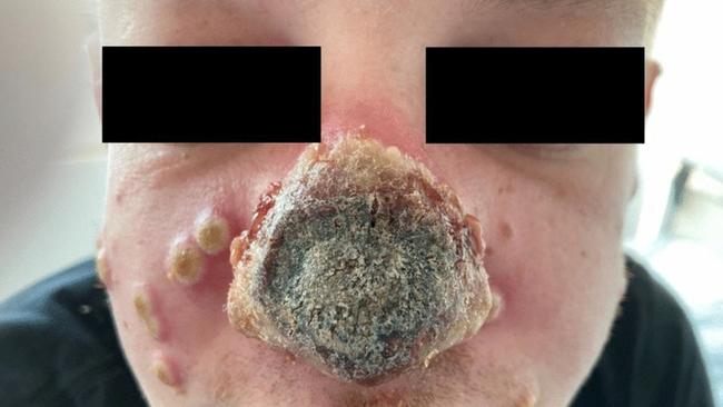 Nasal necrosis and skin lesions due to MPXV (Monkeypox) infection in a patient with advanced undiagnosed HIV infection. Picture: Boesecke et al.