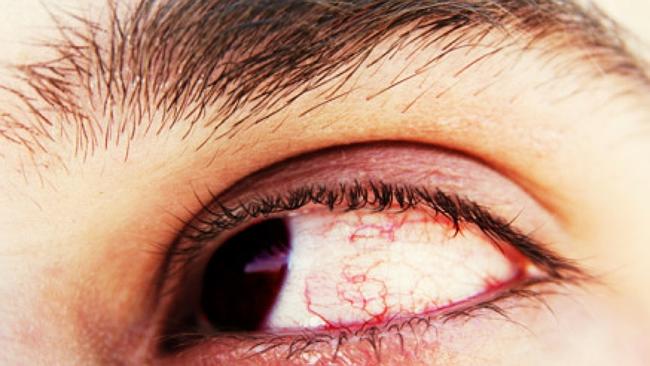 This rare condition can cause you to shed bloody tears