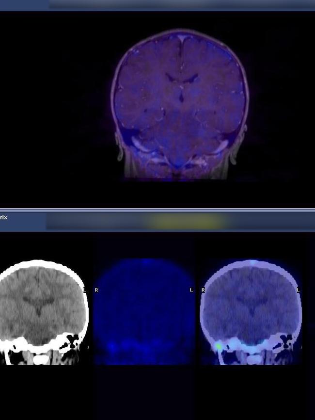 Annabelle Nguyen’s scans after the treatment.