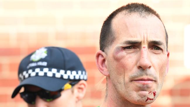 A left-wing protester is seen with facial injuries after a violent scuffle broke out between two opposing groups during a demonstration outside Milo Yiannopoulos's sold out show at the Melbourne Pavilion in Melbourne on Monday, December 4, 2017. Picture: AAP /James Ross.