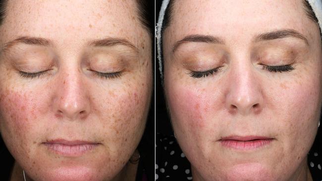 If you have sun damage or pigmentation, this treatment is a game-changer. Picture: Clinica Lase.