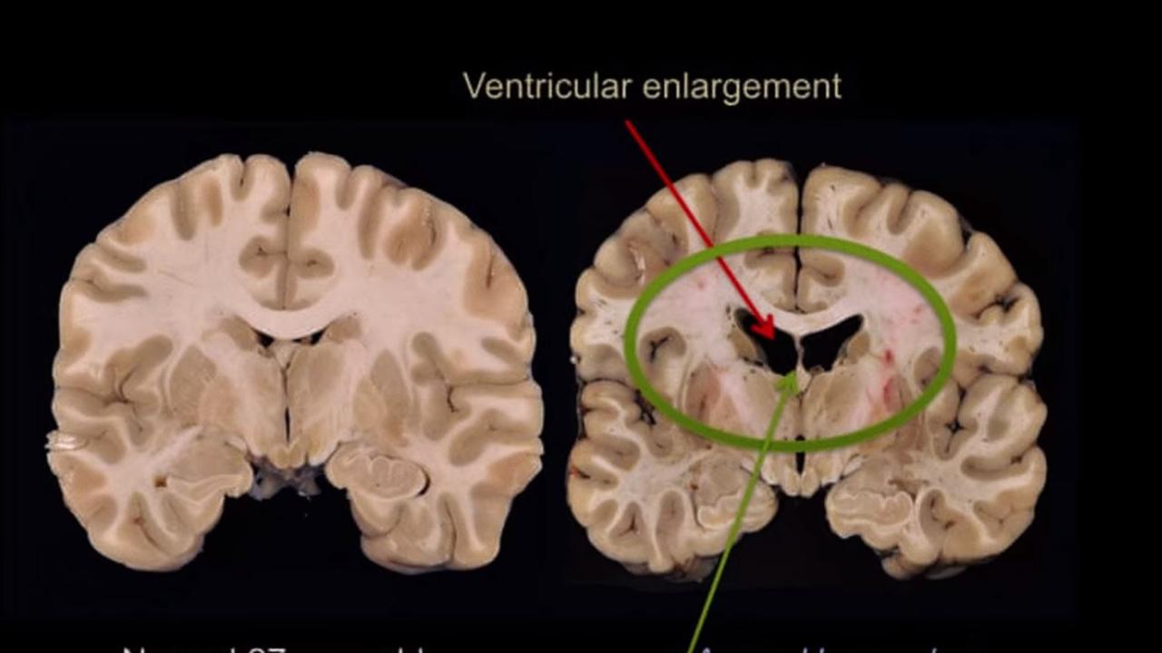 Three former Raiders will donate brains for CTE research