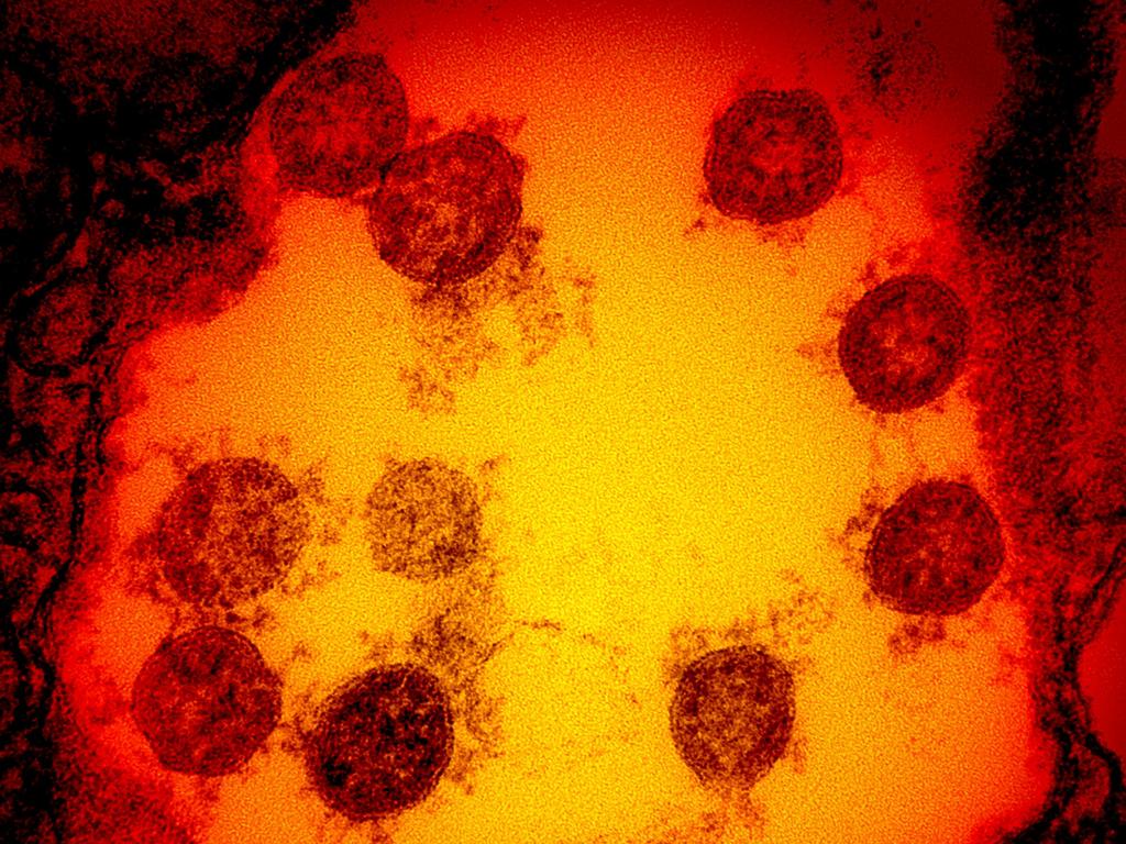 This image obtained by the National Institute of Allergy and Infectious Diseases shows a transmission electron micrograph of SARS-CoV-2 virus particles, isolated from a patient. Picture: AFP