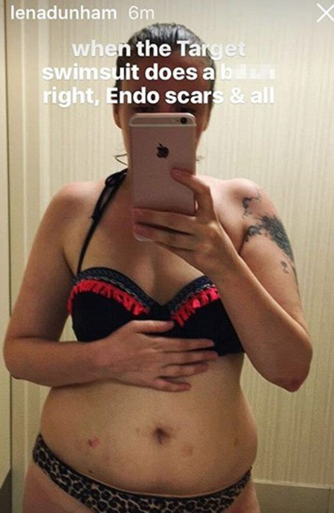 Lena Dunham reveals her scars from endometriosis on social media. Picture: Snapchat