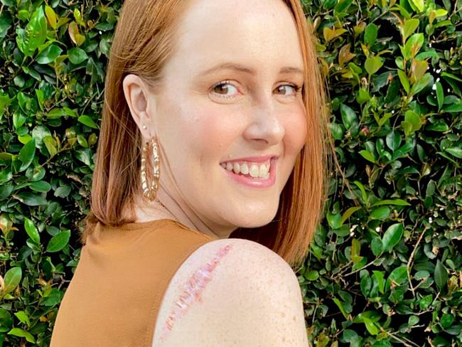 Courtney Mangan had a skin check when she noticed a mole was beginning to change. Picture: Supplied