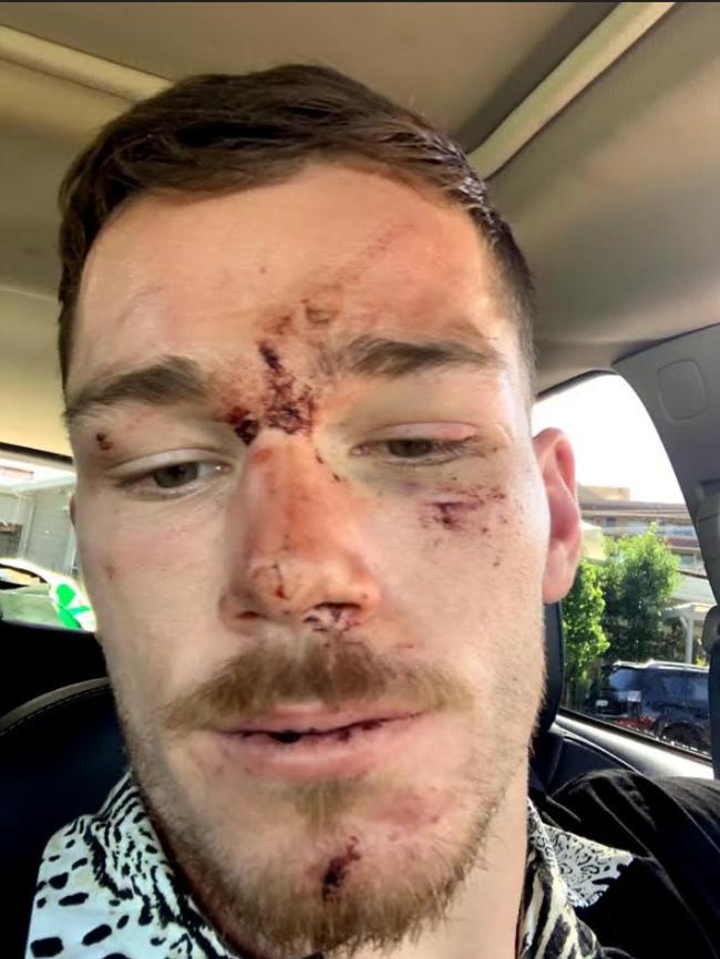 Canberra Raiders player Tom Starling was bloodied and bruised after the brawl.