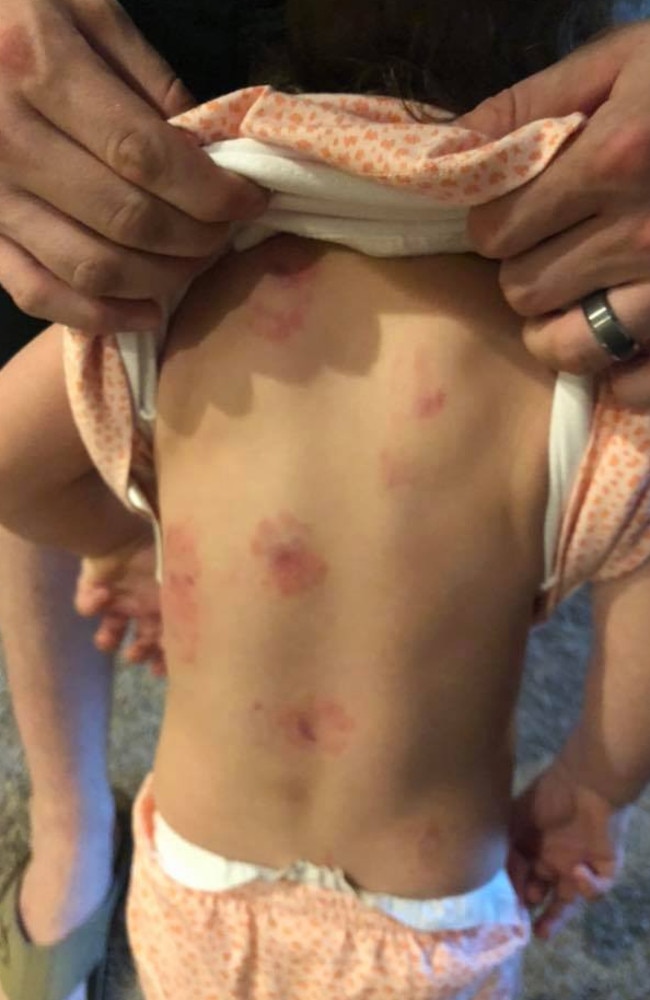 Another Arizona mum has shared shocking images of their child returning home from daycare with bite marks. 