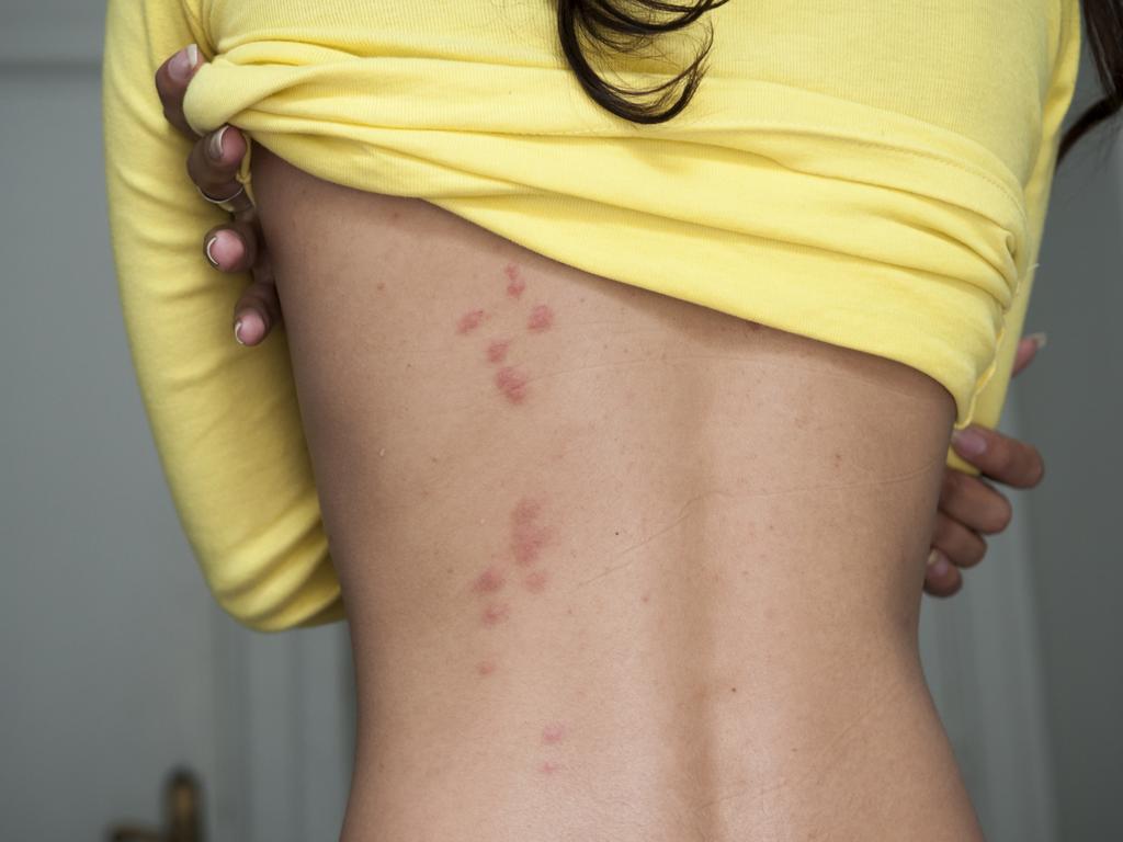 Bites on your upper body are an early indicator of bed bugs. Picture: iStock