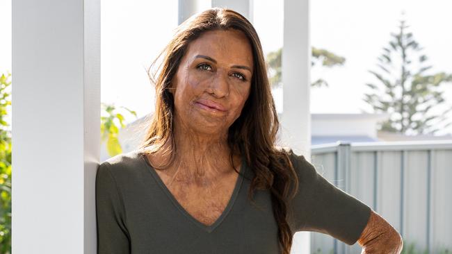 Turia Pitt says it’s easy to assume people on social media have a perfect life. Picture: Supplied