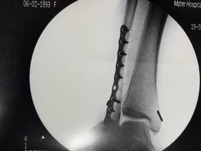 The x-ray showing the plates and screws in Jessica Powell's leg.