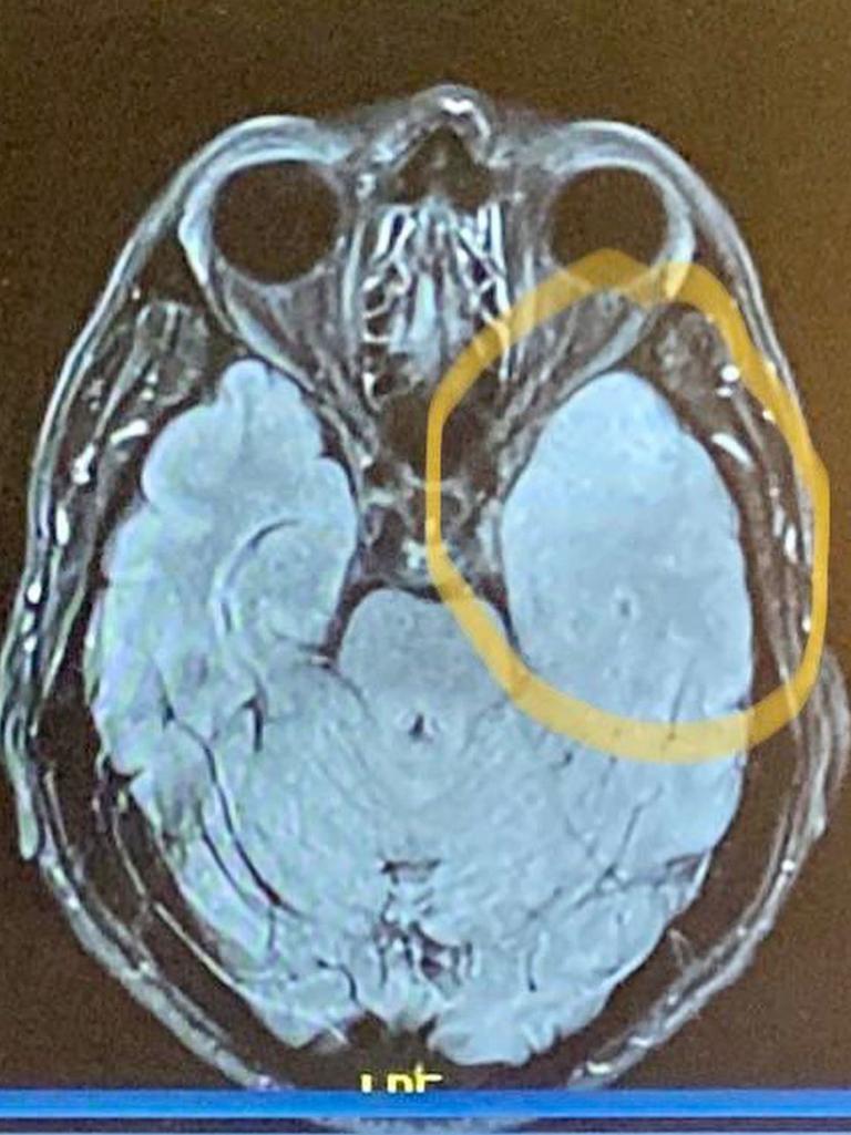An MRI scan showed a tumour on the 56-year-old’s brain. Picture: Instagram@profrscolyer